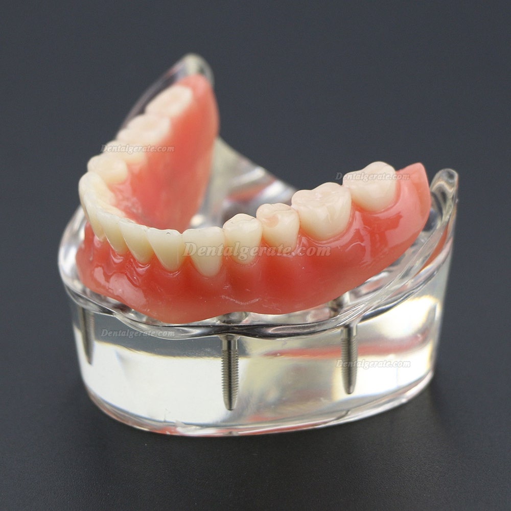 Dental Lower Z&auml;hne Demo-Studienmodell 6002 02 Overdenture Unten 4 Implantate